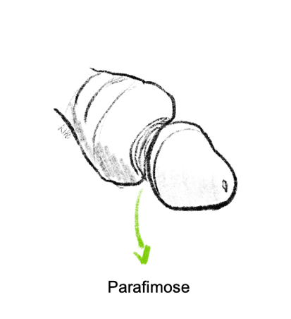 Parafimose