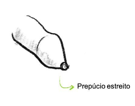 Prepúcio estreito